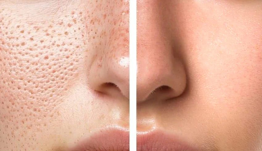 Open Pores Treatment in Udaipur: Myths vs Reality
